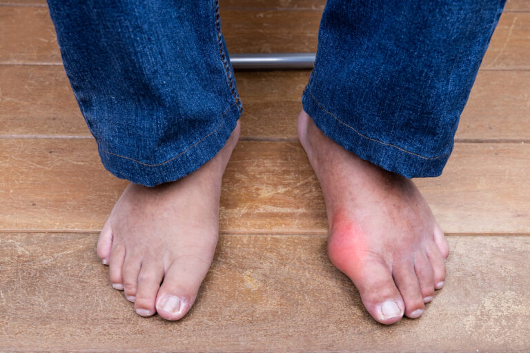 Bunions Causes Symptoms Treatments And Prevention Tips Healthyu